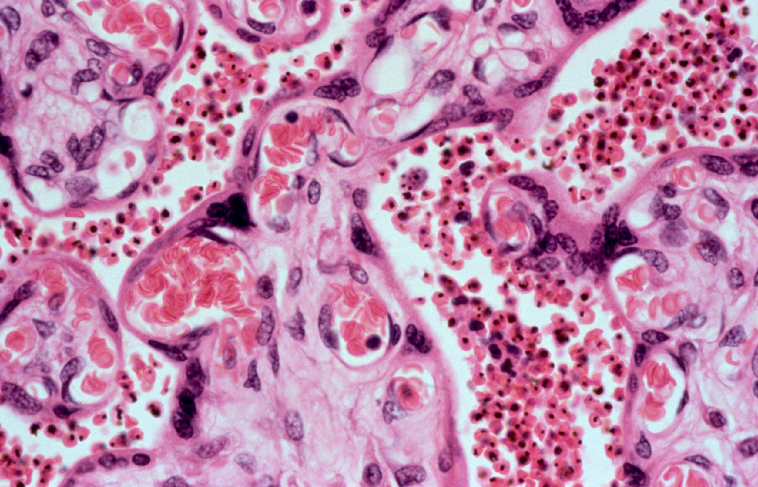 Plasmodium falciparum malaria: placenta.